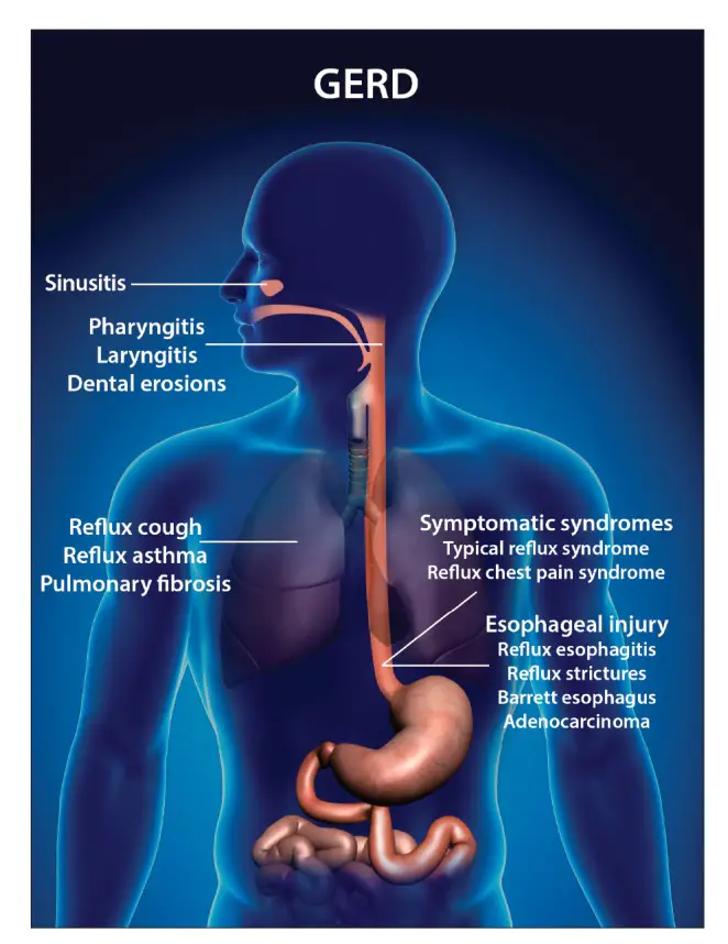 acid reflux and asthma